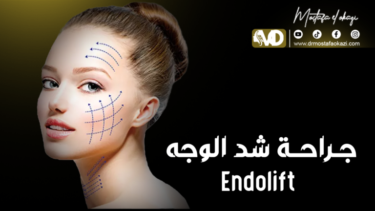 Read more about the article الإندولفت Endolift للوجه